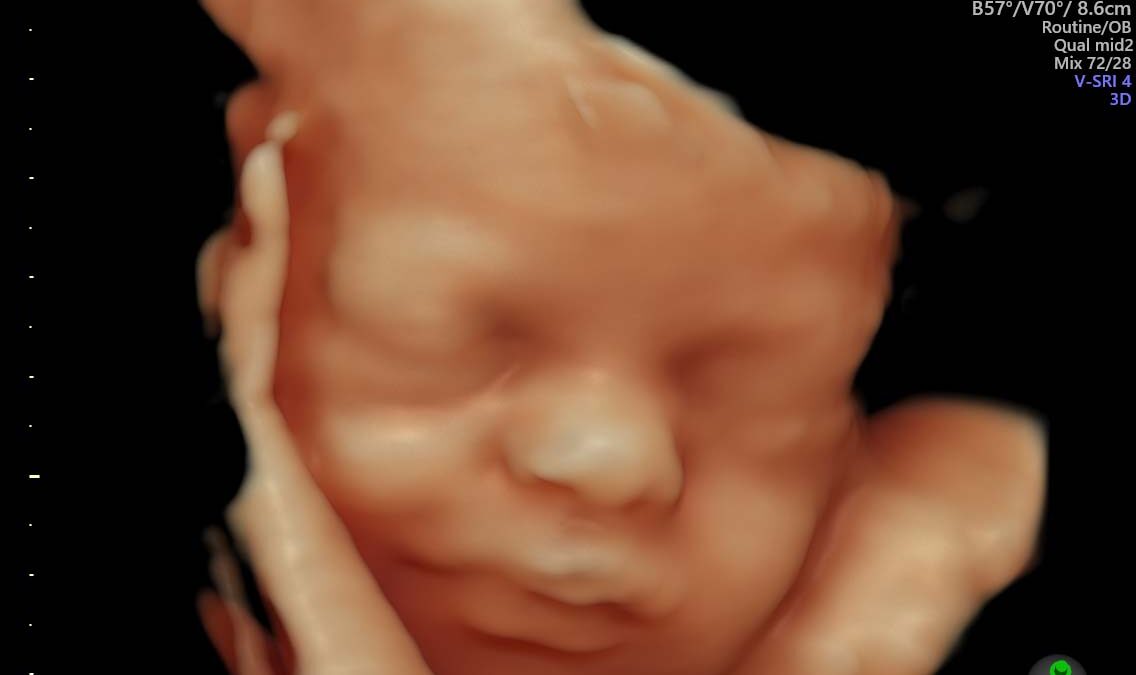 3D colour ultrasound image of baby in the womb